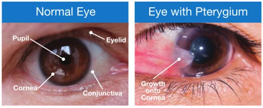 PTERYGIUM SURGERY